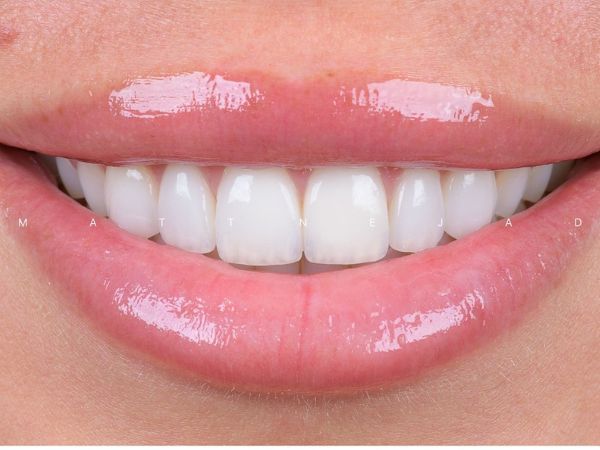 After cosmetic dentistry treatment